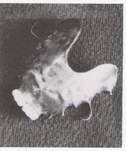 Prothèse amovible partielle supérieure en argent allemand et avec deux dents en ivoire remplaçant deux incisives.