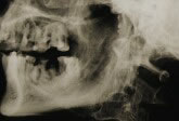 Agrandissement de la radiographie de profil de Ramsès II - Histoire de la médecine