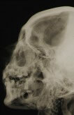 Radiographie de profil du crâne de Ramsès II - Histoire de la médecine