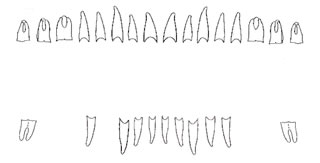 Schéma dentaire post-mortem du crâne supposé de Charlotte de Savoie (1441-1483)