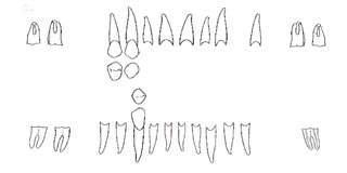 Schéma dentaire post-mortem du crâne supposé de Louis XI (1423-1483)